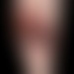 Ulcer of the skin: Pyoderma gangraenosum; chronic, large-area, circulatory ulcer of limited size,...