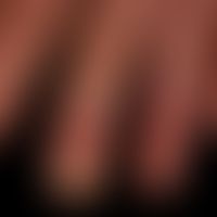 Acrodermatitis continua suppurativa: pronounced, painful, chronic, acral, pustular dermatitis wit...