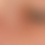 Basal cell carcinoma nodular: 72-year-old female patient. solitary, continuously growing for seve...