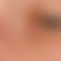 Basal cell carcinoma nodular: 72-year-old female patient. solitary, continuously growing for seve...