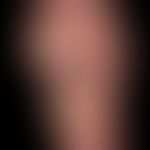 Chilblain lupus: flat, painful, sharply defined redness with scaly deposits on the sole of the fo...