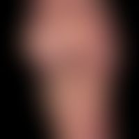 Chilblain lupus: flat, painful, sharply defined redness with scaly deposits on the sole of the fo...