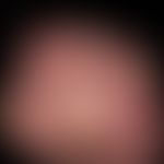 Chilblain lupus: detail detail; extensive, painful, sharply defined redness with scaly deposits o...