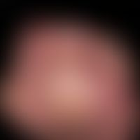 Chilblain lupus: detail detail; extensive, painful, sharply defined redness with scaly deposits o...