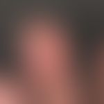 Fingerkuppennale Nekrose des Digitus III bei einer 52-jährigen Patientin mit progressiver ystemis...