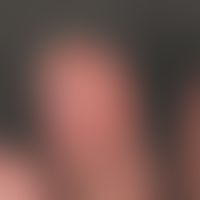 Fingerkuppennale Nekrose des Digitus III bei einer 52-jährigen Patientin mit progressiver ystemis...
