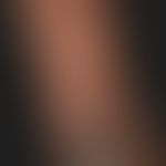 Dermatitis herpetiformis: blisters and bizarrely aggregated blisters on the extensor side of the ...