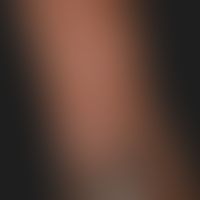 Dermatitis herpetiformis: Bläschen und bizarr aggregierte Blasen an der Streckseite des Oberarms....