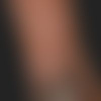 Blisters in dark skin. Absence of any red components.
