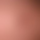 Fibroxanthom atpyisches:&nbsp;rasch wachsender, zentral ulzerierter, schmerzloser Knoten bei eine...