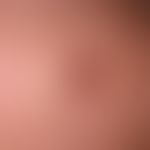 Fibroxanthoma atpyisches: rapidly growing, centrally ulcerated, painless lump in a man (>70 ye...