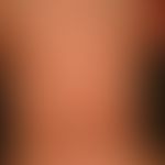 Generalized cGVHD: chronic, generalized, poikilodermatic skin changes, with circumscribed hardeni...