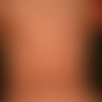 Generalisierte cGVHD:&nbsp;chronische, generalisierte, poikilodermatische Hautveränderungen,&nbsp...