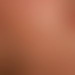 Generalized cGVHD: chronic, generalized, poikilodermatic skin changes, with circumscribed hardeni...