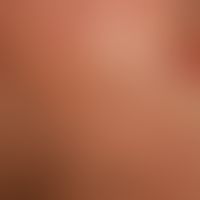 Generalisierte cGVHD:&nbsp;chronische, generalisierte, poikilodermatische Hautveränderungen,&nbsp...