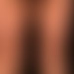 Generalized cGVHD: chronic, generalized, poikilodermatic skin changes, with circumscribed hardeni...