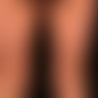Generalisierte cGVHD:&nbsp;chronische, generalisierte, poikilodermatische Hautveränderungen,&nbsp...