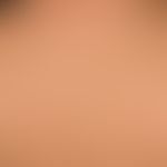 Generalized cGVHD: chronic, generalized, poikilodermatic skin changes, with circumscribed hardeni...