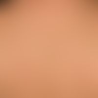 Generalisierte cGVHD:&nbsp;chronische, generalisierte, poikilodermatische Hautveränderungen,&nbsp...