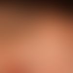 Generalized cGVHD: chronic, generalized, poikilodermatic skin lesions, with circumscribed hardeni...