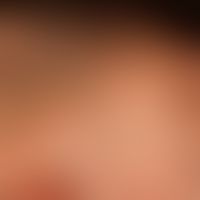 Generalisierte cGVHD:&nbsp;chronische, generalisierte, poikilodermatische Hautveränderungen,&nbsp...