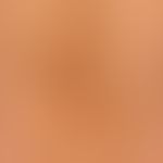 Generalized cGVHD: chronic, generalized, poikilodermatic skin changes, with circumscribed hardeni...