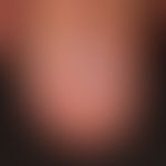 Graham-Little syndrome: irreversibly scarred (10 nail) onychodystrophy and lymphocytic scarring a...