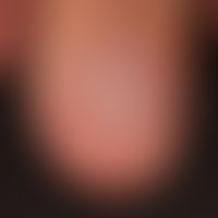 Graham-Little syndrome: irreversibly scarred (10 nail) onychodystrophy and lymphocytic scarring a...