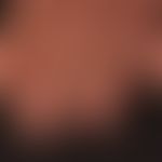 Graham-Little syndrome: pronounced scarring (10 nail) onychodystrophy and lymphocytic, scarring a...