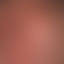 Lichen planus follicularis mit flächenhafter vernarbenden&nbsp;Alopezie. Auffällig ist die pergam...