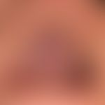 Lichen planus mucosae: massive, complete infestation of the hard palate with whitish-grey, extens...