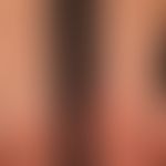 Lichen planus (classic type): for several weeks, red, itchy, polygonal, in places linearly conflu...