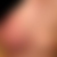 Lymphangiosis carcinomatosa:&nbsp;Seit etwa 2 Jahren bestehender, stetig progedienter, mäßig schm...
