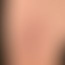 Primär kutanes Marginalzonenlymphom: lokalisierte&nbsp;&nbsp;seit mehreren Monaten bekannte, nur ...