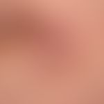 Dermatofibrosarcoma protuberans: derber, plattenartig die Haut infiltrierender, unscharf bgrenzte...
