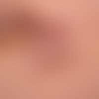 Dermatofibrosarcoma protuberans: coarse, plate-like lumps infiltrating the skin, blurredly delimi...