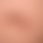 Dermatofibrosarcoma protuberans: derber, plattenartig die Haut infiltrierender, unscharf bgrenzte...