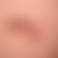 Dermatofibrosarcoma protuberans: coarse, plate-like lump infiltrating the skin, blurredly delimit...