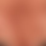 Pemphigus vulgaris:&nbsp;multiple, chronische, seit mehreren&nbsp;Jahren schubweise verlaufende, ...