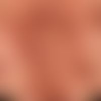 Pemphigus vulgaris:&nbsp;multiple, chronische, seit mehreren&nbsp;Jahren schubweise verlaufende, ...