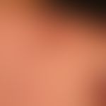 Pemphigus vulgaris. Multiple, seit mehreren&nbsp;Jahren schubweise verlaufende,&nbsp; braun-rote ...