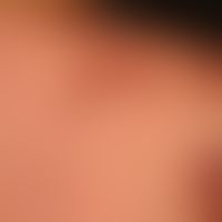 Pemphigus vulgaris. Multiple, seit mehreren&nbsp;Jahren schubweise verlaufende,&nbsp; braun-rote ...
