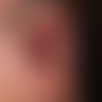 Pemphigus vulgaris: chronisch persistierende, großflächige , schmerzhafte Erosionen an Wangenschl...