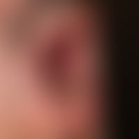 Pemphigus vulgaris: chronisch persistierende, großflächige , schmerzhafte Erosionen an Wangenschl...
