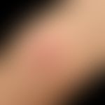 Acrodermatitis enteropathica: secondary zinc deficiency in chronic inflammatory disease of the ga...