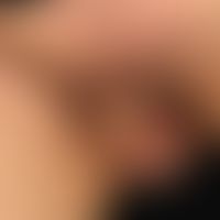 Lymphangiosis carcinomatosa bei vorbekanntem Analkarzinom. Multiple hautfarbene, feste, oberfläch...