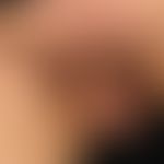 Skin metastases: Multiple slightly reddish, surface-smooth nodules and plaques in previously know...