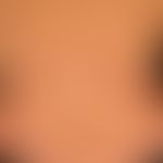 Erythema gyratum repens: chronically dynamic (changeable course for several months), confluent an...