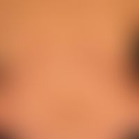 Erythema gyratum repens: chronically dynamic (changeable course for several months), confluent an...