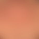 Feldkanzerisierung: flächig hyperpigmentierte Haut mit multiplen&nbsp;aktinischen Keratosen. Größ...